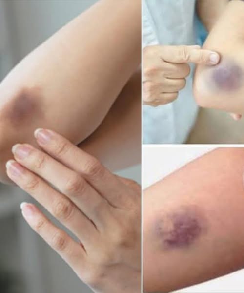 BE CAREFUL, if you get these bruises on your body, here’s what it means