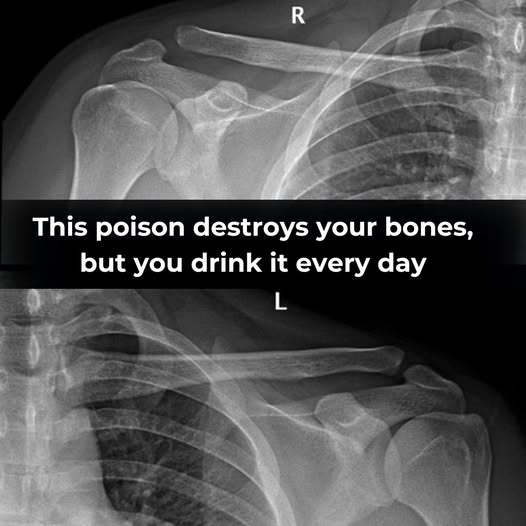 This Drink Will Destroy Your Bones From The Inside But Everyone Drinks It Anyway