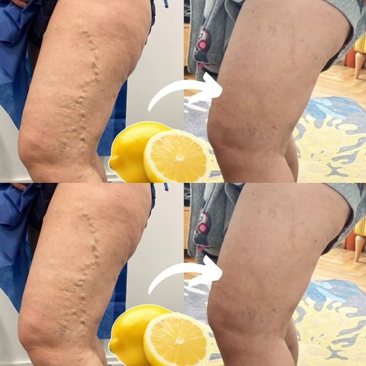 Natural Lemon Remedy for Varicose Veins: Simple and Effective