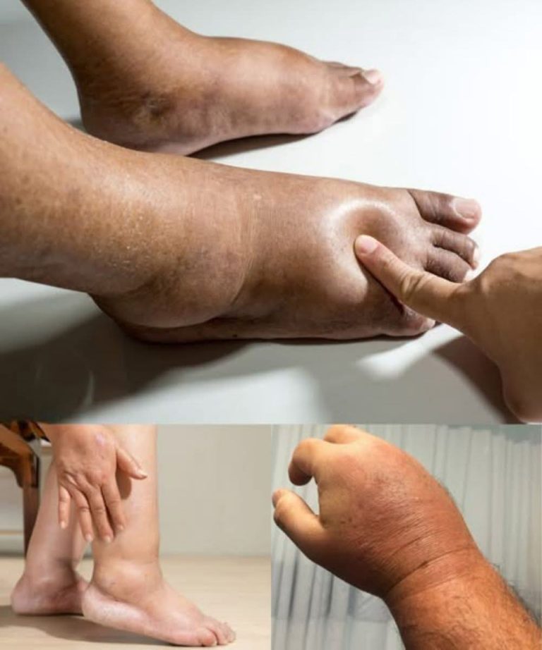 Foods That Help Reduce Swollen Hands or Feet