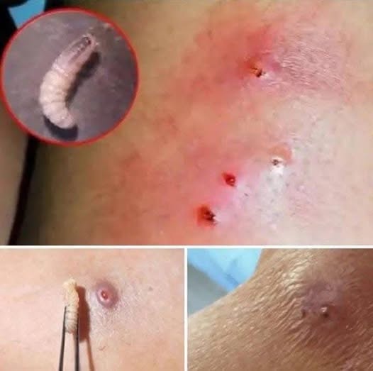 Larvae Found in Young Woman…See More