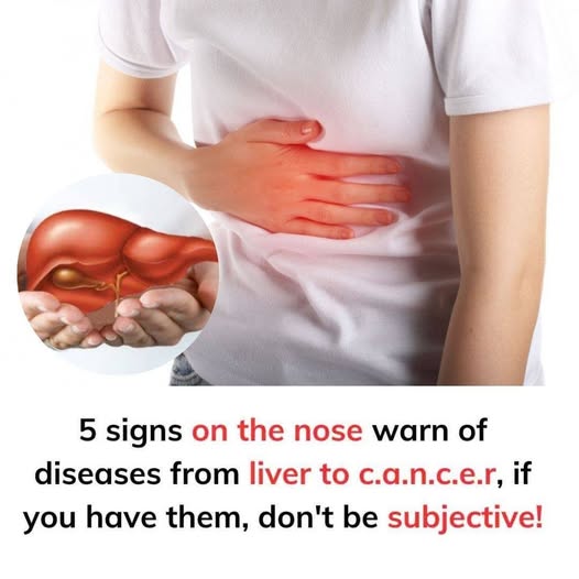 5 signs on the nose warn of diseases