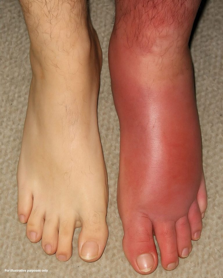 What Does It Mean When One Leg Suddenly Becomes Red and Swollen?