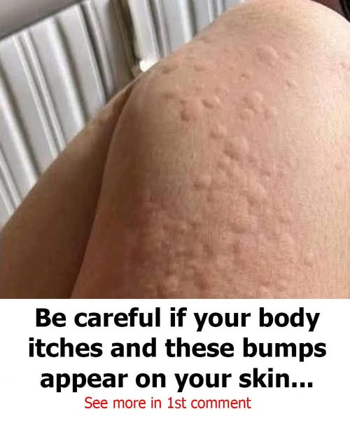 Why do hives appear on the skin? These are the surprising factors you might not know about.