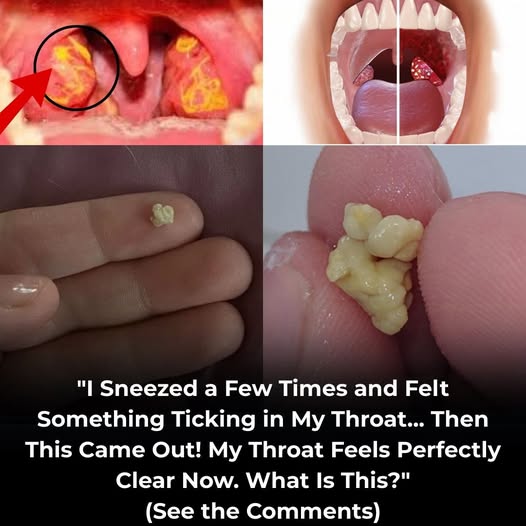 Everything you need know about tonsil stones, odd growths that seem like pimples in your throat.