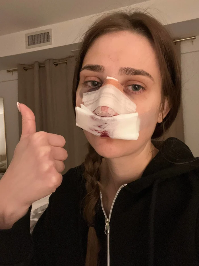 People Can’t Believe How This Woman Looks After Getting A $11k Nose Job