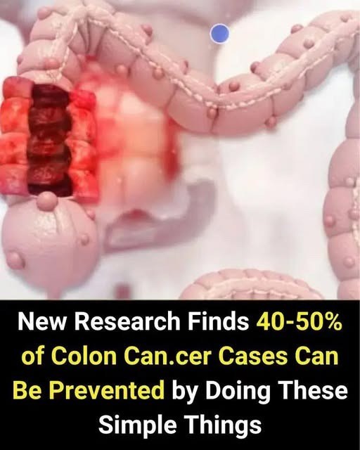 New Research Finds 40-50% of Colon Can.cer Cases Can Be Prevented by Doing These Simple Things