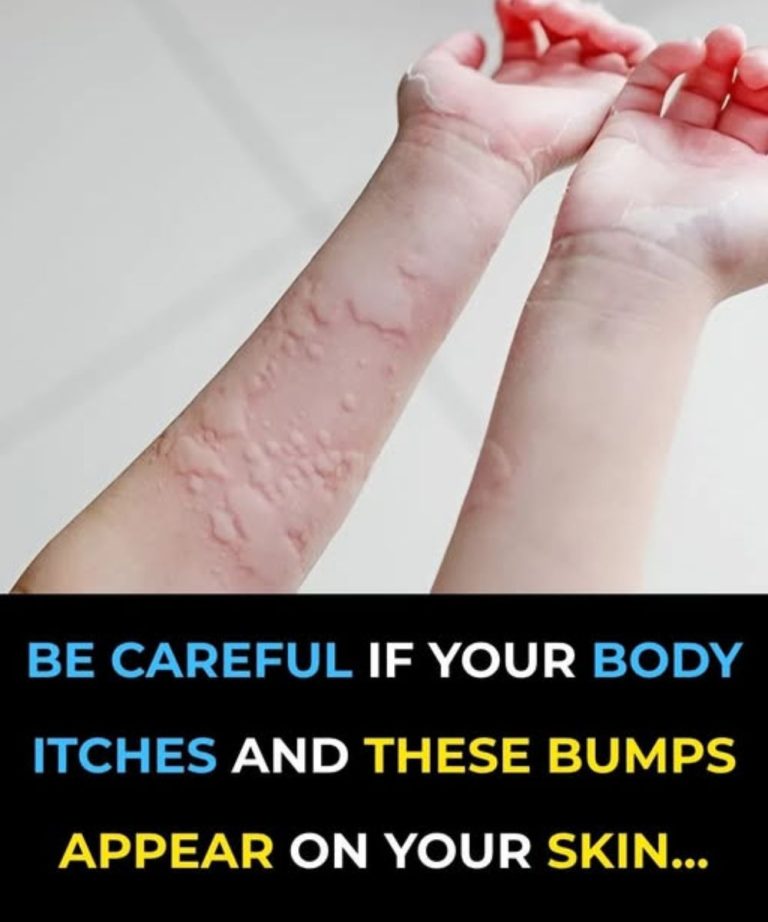 Amazing Causes Of Hives Revealed