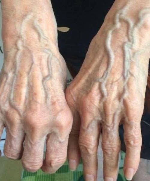 If your veins are visible in your hand, it is a signal of ca… See more