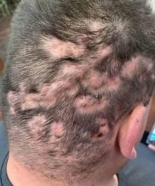 These are the first symptoms that are cre… See more