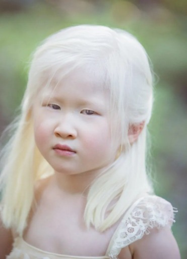 A baby girl born with albinism was abandoned by her parents.