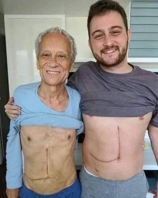 Son Who Donated Part of His Liver to Save His Father Faces an Unthinkable Tragic Outcome, Turning a Selfless Act of Love Into a Heartbreaking Story That Shocks the Community, Raises Painful Questions About Fate, Sacrifice, and the Fragile Line Between Hope, Survival, and Devastating Loss