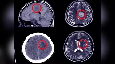 ⚠️ 12 Signs That May Signal a Brain Aneurysm — Don’t Ignore Them (Early Recognition Could Save Your Life) 🧠