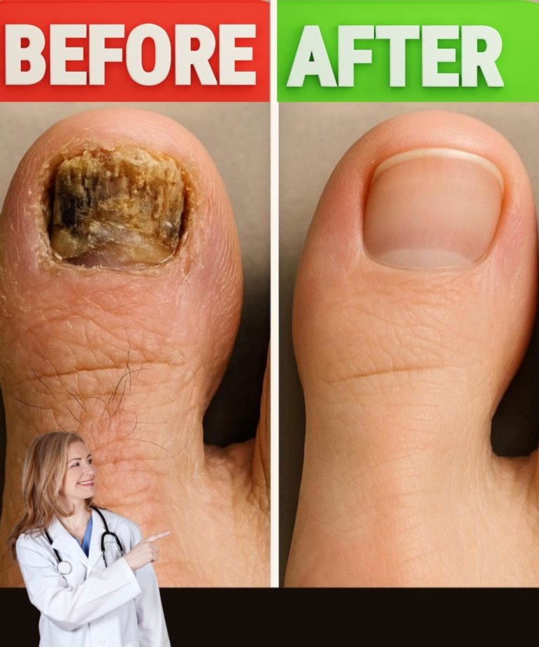 Home Remedy for Toenail Fungus: Before and After