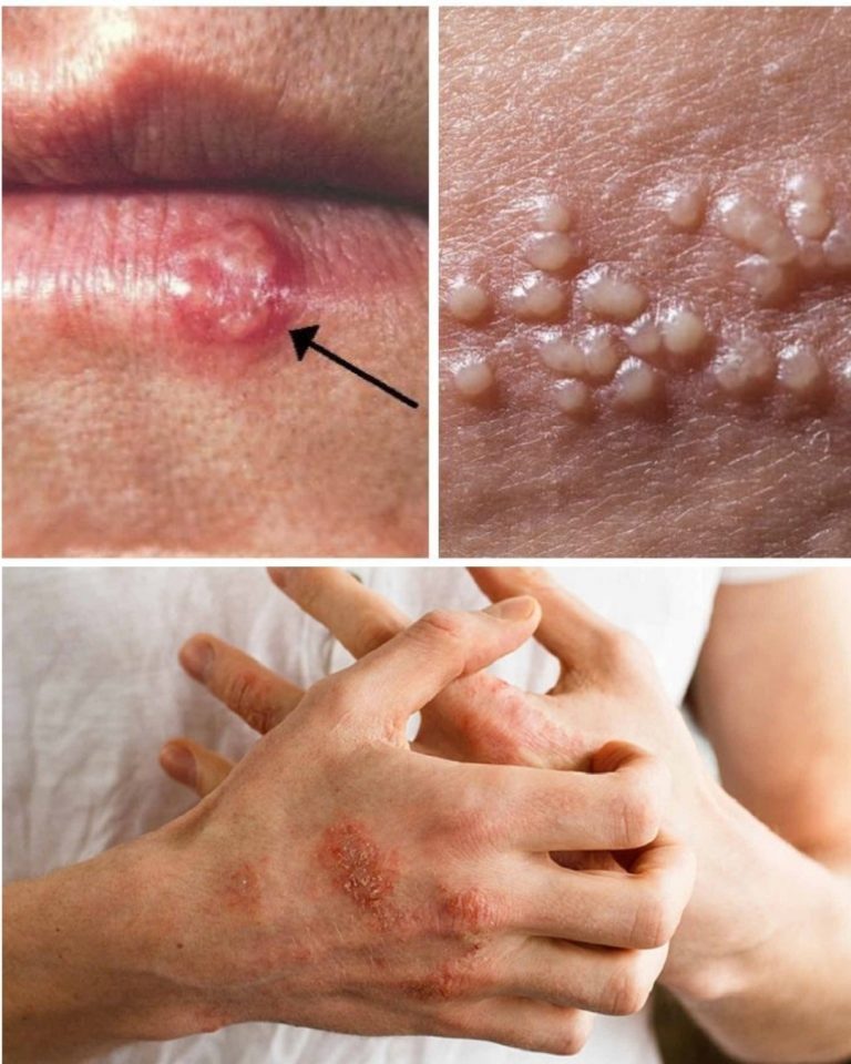 Recurrent Rashes or Blisters on Lips or Private Areas? This Is NOT Normal – Here’s What Your Body Is Telling You