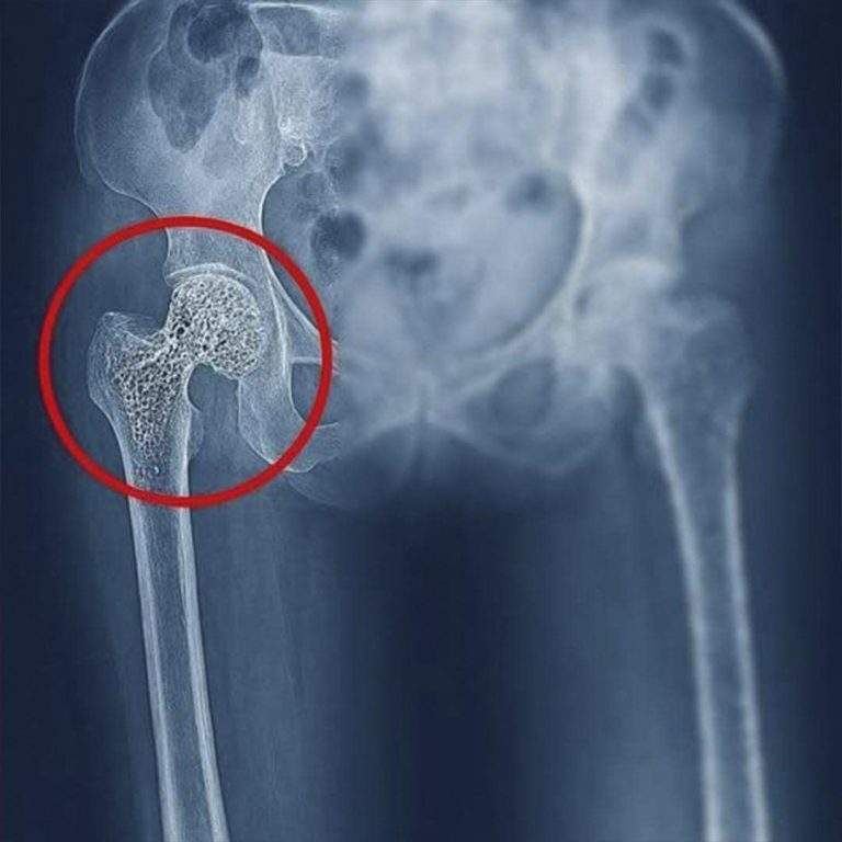 The image of a damaged hip