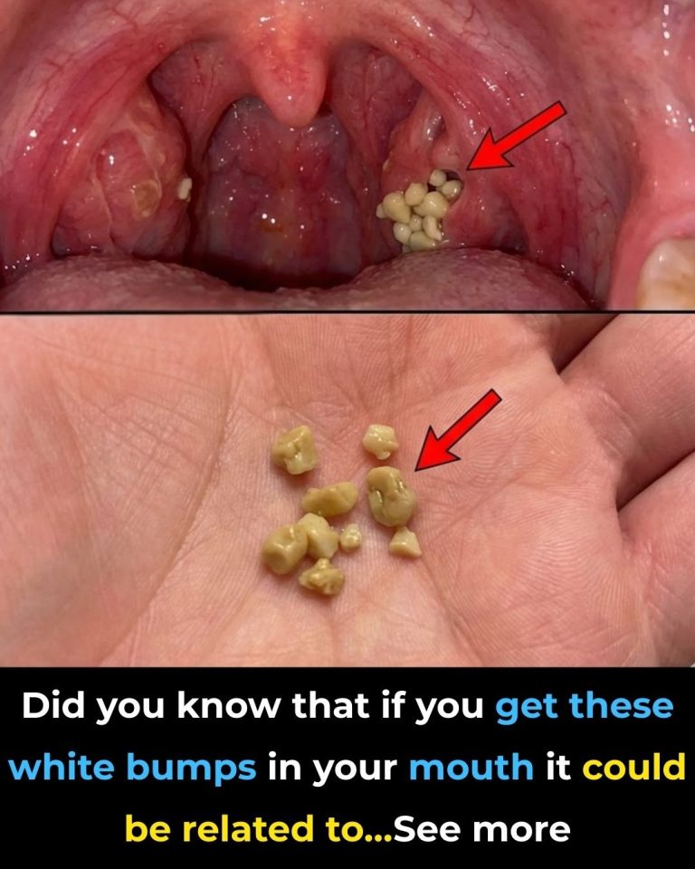 Tonsil Stones: What They Are, How to Spot Them, and How to Get Rid of Them for Good