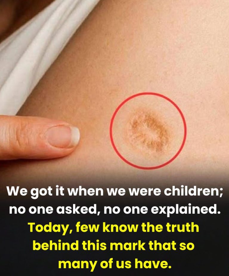 5 Common Misconceptions About the Round Scar on the Upper Arm