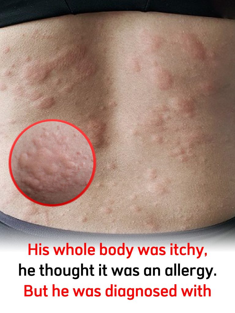 His whole body was itchy, he thought it was an allergy and was diagnosed