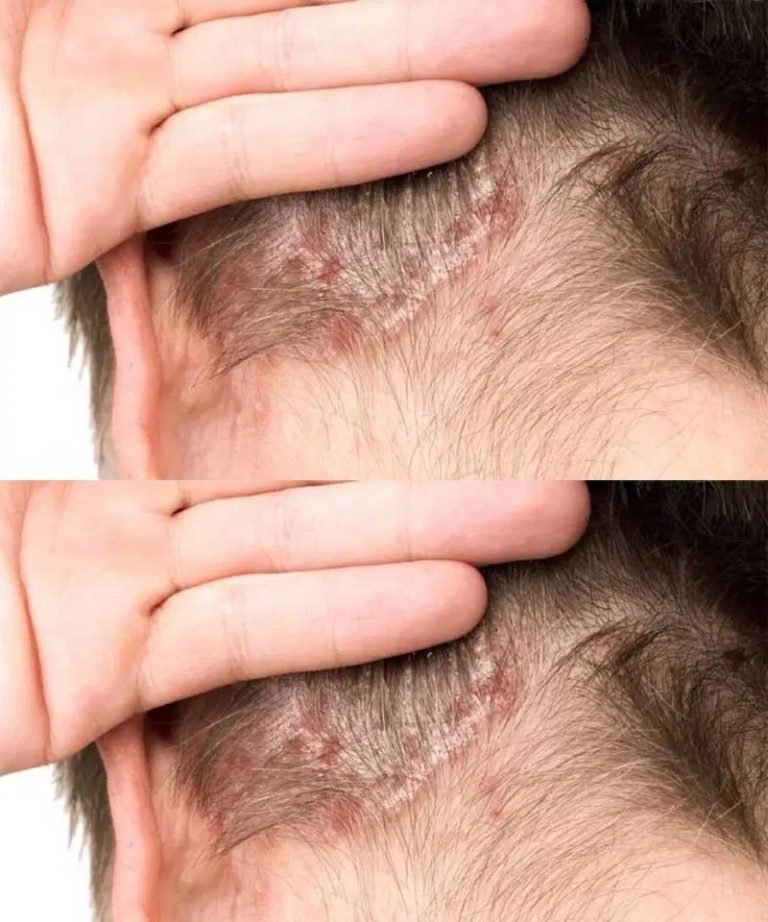 Scaly Patch on a Child’s Scalp: What It Could Be and What Parents Should Know