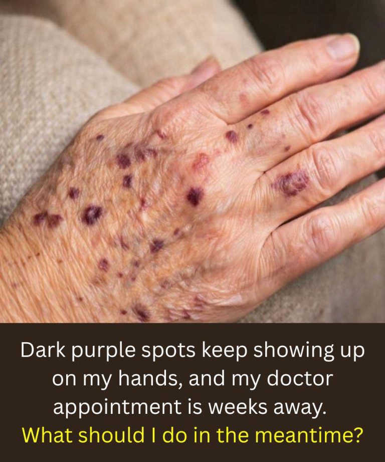 Dark purple spots keep showing up on my hands, and my doctor appointment is weeks away. What should I do in the meantime?