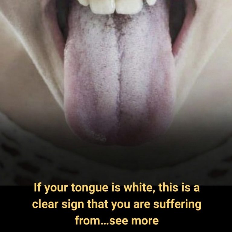 If your tongue is white, this is a clear sign that you are suffering from