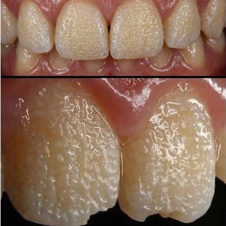 Be Careful! This Is What Can Happen to Your Teeth When You Eat Certain Everyday Foods and Drinks That Slowly Damage Enamel, Cause Staining, Increase Sensitivity, and Lead to Long-Term Dental Problems You Might Not Notice Until It’s Too Late to Reverse the Effects