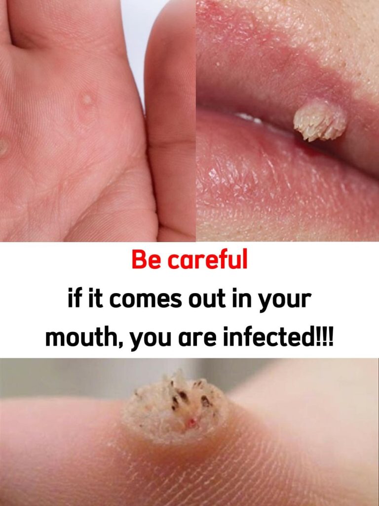 Natural Wart Removal: Simple Methods That Might Actually Work