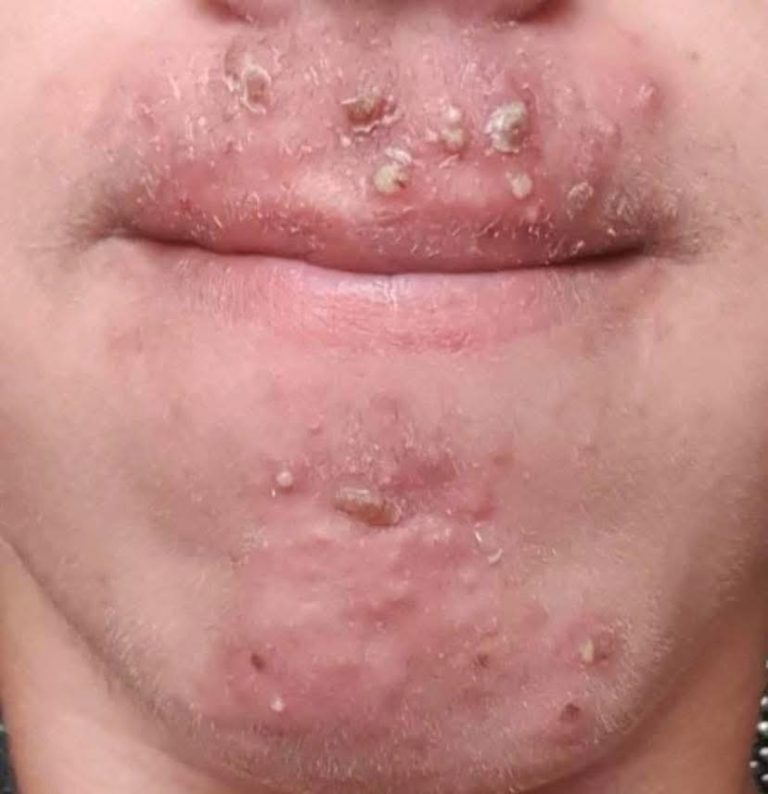 Been dating this woman I met at Walmart and after finally getting some I woke up with these on my face what is this?